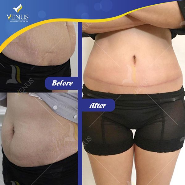 BS Nguyễn Đắc Linh giúp chị em tìm lại sự tự tin nhờ phẫu thuật tạo hình thành bụng - 3