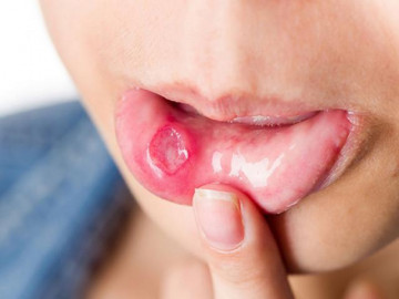 Bị nhiệt miệng nên và không nên ăn gì?