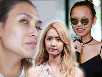 Tưởng làn da hoàn hảo, dàn mỹ nhân cũng từng khóc ròng vì mụn chi chít kéo đầy lên mặt