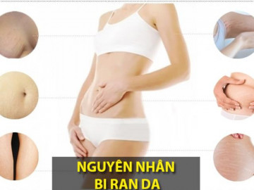 Trị rạn da sau sinh lâu năm hiệu quả nhanh nhất hiện nay