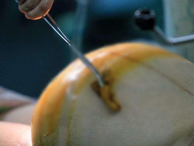 Sau sinh mổ bao lâu nên có thai lại? Không phải 3 năm hay 5 năm!