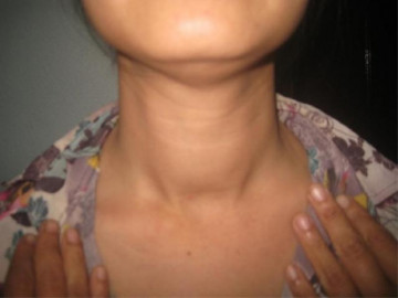 Bệnh cường giáp nên ăn gì?