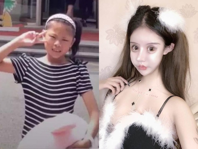 Cô gái phẫu thuật thẩm mỹ từ năm 13 tuổi, 3 năm 60 lần dao kéo giờ ra sao?