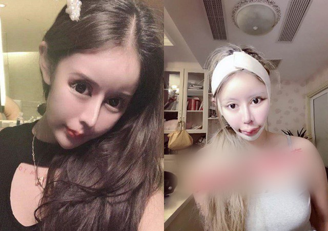 Cô gái phẫu thuật thẩm mỹ từ năm 13 tuổi, 3 năm 60 lần amp;#34;dao kéoamp;#34; giờ ra sao? - 1