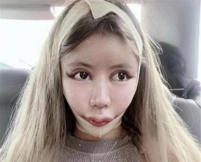 Cô gái phẫu thuật thẩm mỹ từ năm 13 tuổi, 3 năm 60 lần amp;#34;dao kéoamp;#34; giờ ra sao? - 3