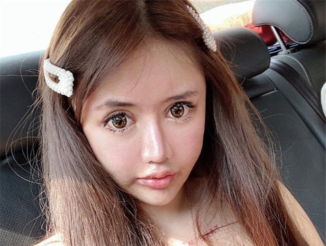 Cô gái phẫu thuật thẩm mỹ từ năm 13 tuổi, 3 năm 60 lần amp;#34;dao kéoamp;#34; giờ ra sao? - 4