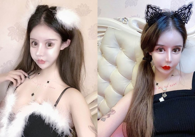 Cô gái phẫu thuật thẩm mỹ từ năm 13 tuổi, 3 năm 60 lần amp;#34;dao kéoamp;#34; giờ ra sao? - 5