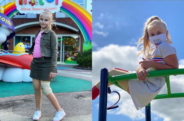 Bé gái sinh ra với chân 5cm, 18 tháng phải cắt cụt chân, sau 10 năm trở thành hiện tượng - 11