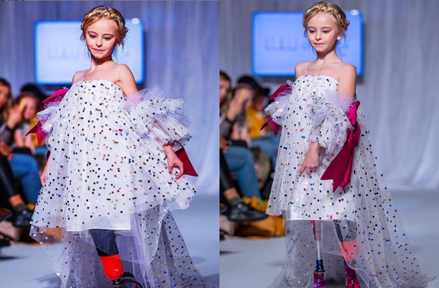 Bé gái sinh ra với chân 5cm, 18 tháng phải cắt cụt chân, sau 10 năm trở thành hiện tượng - 4