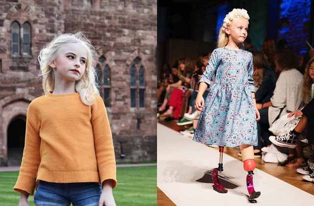 Bé gái sinh ra với chân 5cm, 18 tháng phải cắt cụt chân, sau 10 năm trở thành hiện tượng - 9