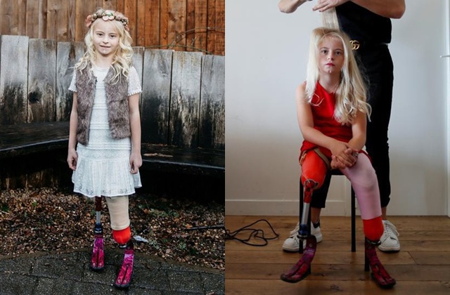 Bé gái sinh ra với chân 5cm, 18 tháng phải cắt cụt chân, sau 10 năm trở thành hiện tượng - 10