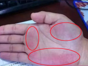 Sức khỏe - 3 dấu hiệu trên tay cảnh báo sớm ung thư gan, có 1 trong 3 cũng nên kiểm tra sớm