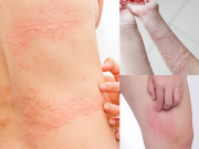 Làm đẹp - Thay đổi thời tiết: dị ứng mề đay không chừa một ai và cẩm nang điều trị nhanh chóng