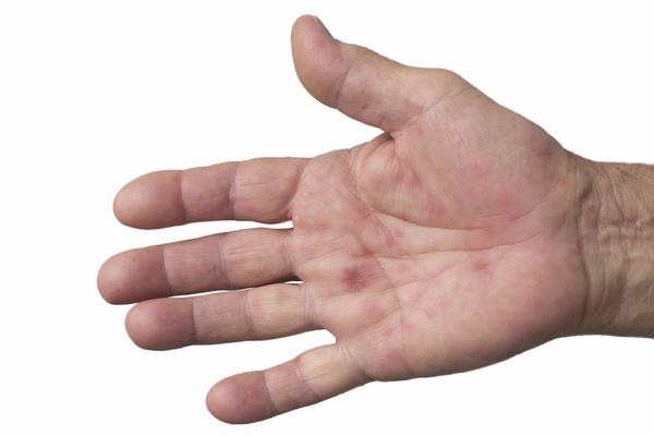 3 dấu hiệu trên tay cảnh báo sớm ung thư gan, có 1 trong 3 cũng nên kiểm tra sớm - 2