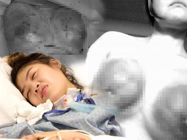 Chi tiền đi nâng ngực: Người phải cắt bỏ cả vòng 1, người sống thực vật đến hết đời