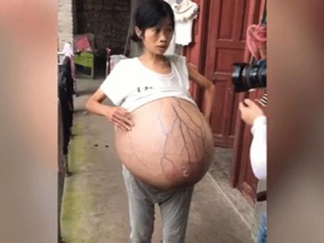 Clip Eva - Người phụ nữ bụng phình to suốt hai năm không rõ nguyên nhân