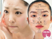 Làm đẹp - 6 vị trí mụn mọc thường gặp trên gương mặt nói gì về tình trạng cơ thể bạn?