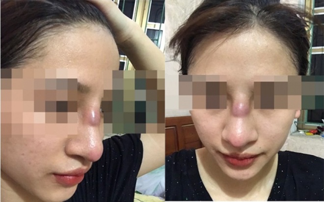 Sửa mũi có vô vàn biến chứng, nhưng khó tin nhất là làm anh chàng amp;#34;chào cờamp;#34; suốt 3 tháng - 7