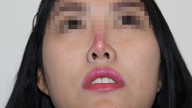 Sửa mũi có vô vàn biến chứng, nhưng khó tin nhất là làm anh chàng amp;#34;chào cờamp;#34; suốt 3 tháng - 6