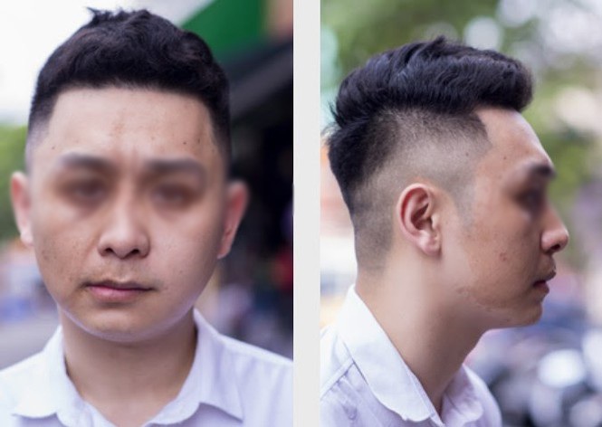 Sửa mũi có vô vàn biến chứng, nhưng khó tin nhất là làm anh chàng amp;#34;chào cờamp;#34; suốt 3 tháng - 8
