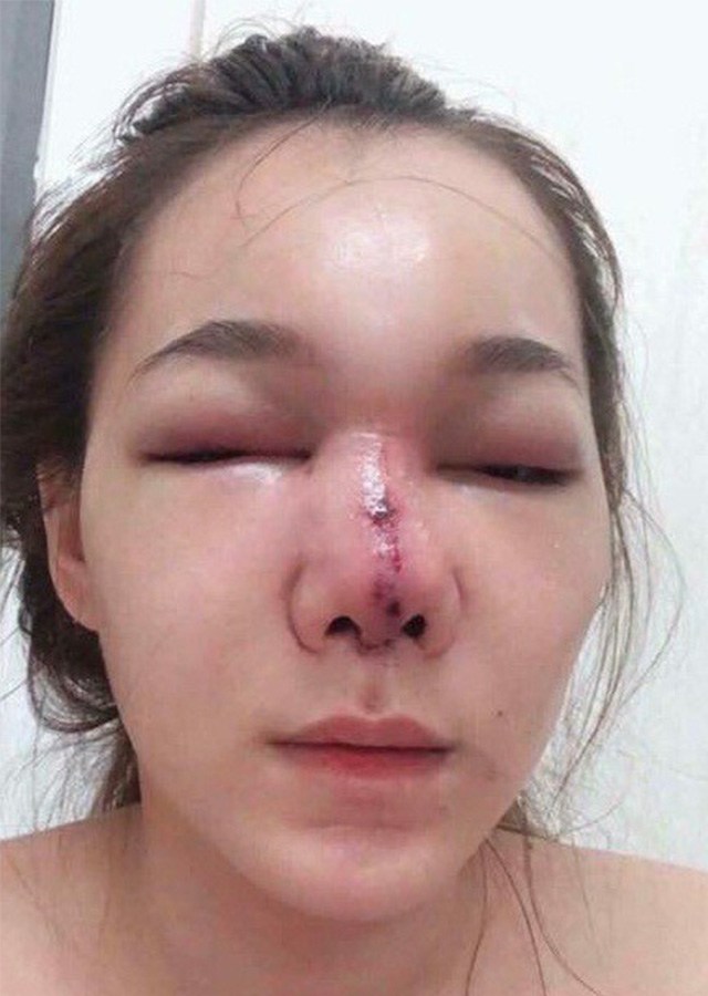 Sửa mũi có vô vàn biến chứng, nhưng khó tin nhất là làm anh chàng amp;#34;chào cờamp;#34; suốt 3 tháng - 5