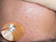 Làm đẹp - 5 cách trị mụn ẩn trên trán tại nhà giúp nhân tự khắc trồi lên mà không cần nặn