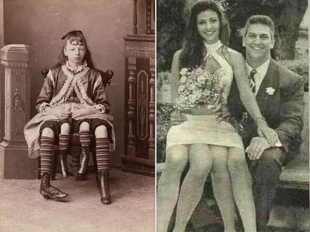 Cô gái 4 chân, 2 bộ phận sinh dục: Lấy chồng sinh 5 con, đem bản thân làm triển lãm