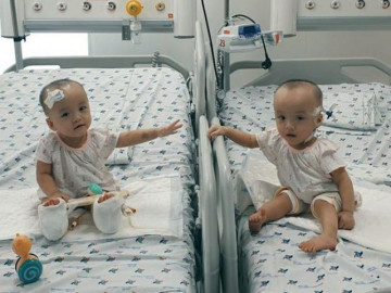 Hơn 1 tháng sau ca mổ tách, Trúc Nhi đã tháo nẹp bột chân, hai chân tự do di chuyển