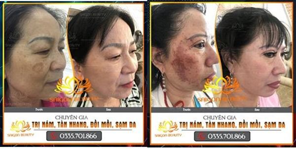 Trị nám, tàn nhang uy tín tại TMV SaiGon Beauty - 4