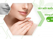 Làm đẹp - Tẩy nốt ruồi tại nhà và những lưu ý cần biết để tránh hậu quả khôn lường