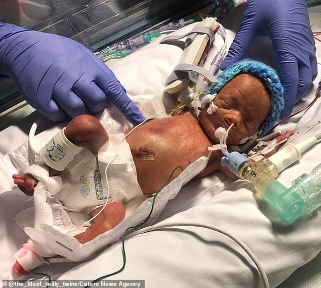 Sản phụ đang chuyển dạ thì hết đau, cặp sinh đôi chào đời cách nhau tận 2 ngày - 1