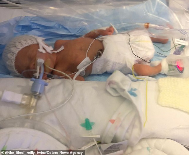 Sản phụ đang chuyển dạ thì hết đau, cặp sinh đôi chào đời cách nhau tận 2 ngày - 2