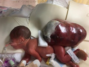 Làm mẹ - Bé gái chào đời vác khối u khổng lồ, sau 1 năm phẫu thuật giờ đẹp như thiên thần