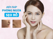 Làm đẹp - Tuyệt đối không được làm những điều sau, da mặt sẽ xấu đi vì sẹo rỗ