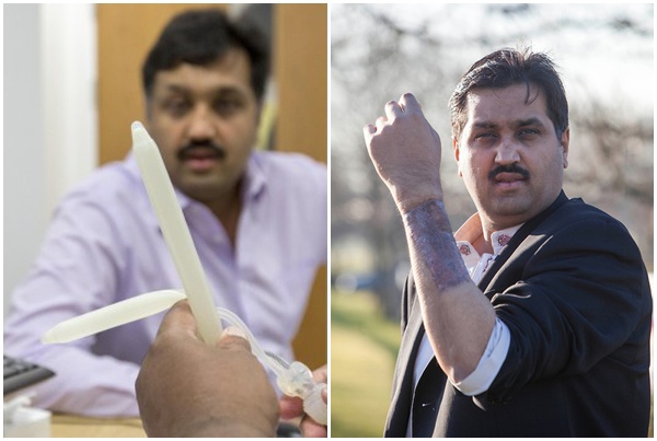 Người đàn ông thành công lắp amp;#34;cậu nhỏamp;#34; giả sau khi gặp tai nạn giao thông - 2