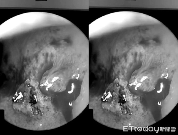 Đang amp;#34;lên đỉnhamp;#34; bỗng chảy máu mũi nửa tiếng không hết, lý giải của bác sĩ còn bất ngờ hơn - 1
