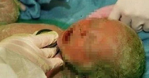 Mổ đẻ cho sản phụ sinh non, lúc lấy em bé ra bác sĩ vừa nhìn đã sốc - 4