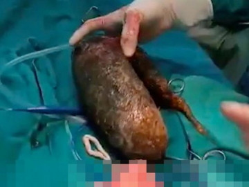 Thiếu nữ thích ăn tóc suốt nhiều năm, bác sĩ lôi ra thứ khủng khiếp trong bụng