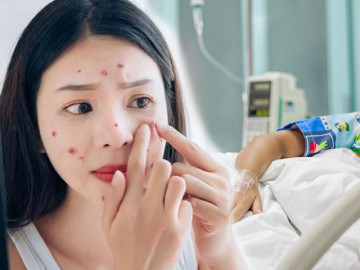 Táy máy nặn mụn, cô gái bị viêm nội sọ: Những vùng mụn nguy hiểm chị em cần biết