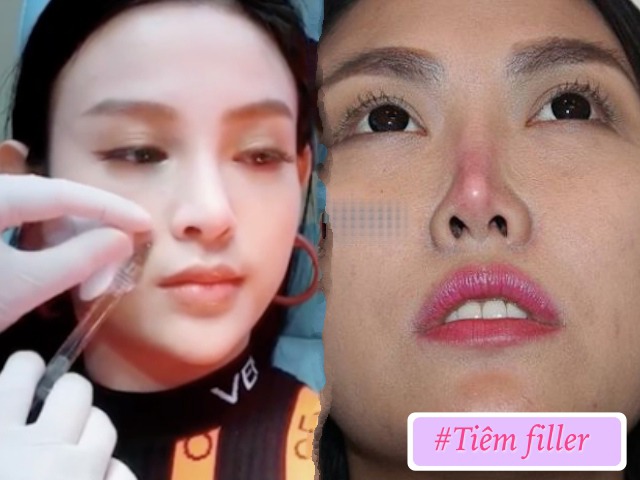 Mê tiêm filler giá rẻ, nhiều chị em đối mặt hậu quả rùng mình: mặt sưng, mũi mưng mủ