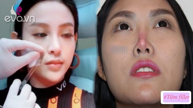 Mê tiêm filler giá rẻ, nhiều chị em đối mặt hậu quả rùng mình: mặt sưng, mũi mưng mủ