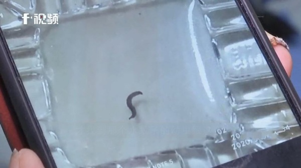 Hai chị em đều bị đau khi đi vệ sinh, BS bất ngờ phát hiện thứ này trong nước tiểu - 1