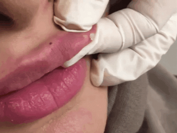 Muốn tiêm filler làm đẹp, nàng nên nắm những lưu ý sau để tránh tiền mất tật mang - 6