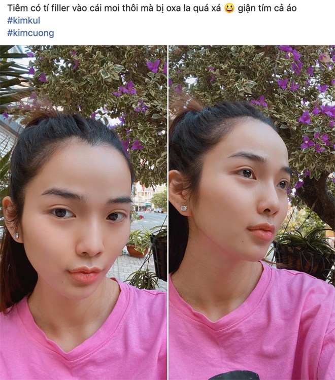 Đu mốt bơm môi gợi cảm: vợ Ưng Hoàng Phúc bị chồng la, có cô dày cộm cứng đờ - 7