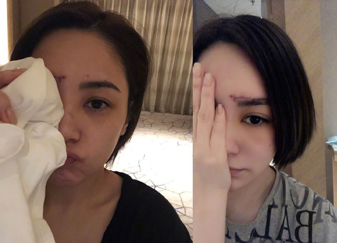 Ngôi sao 24/7: Chung Hân Đồng phải khâu hơn 60 mũi trên mặt, vết sẹo dài trông đáng sợ - 1