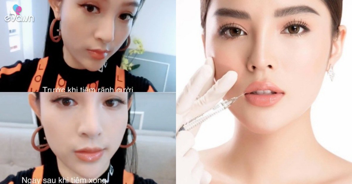 Những bộ phận có thể làm đẹp bằng filler giúp chị em lên đời nhan sắc