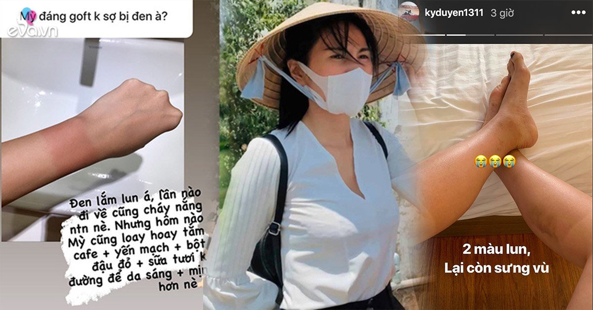 Sao Việt cháy nắng sau mùa hè: loạt Hoa hậu da hai màu, Thuỷ Tiên kêu trời vì hậu quả