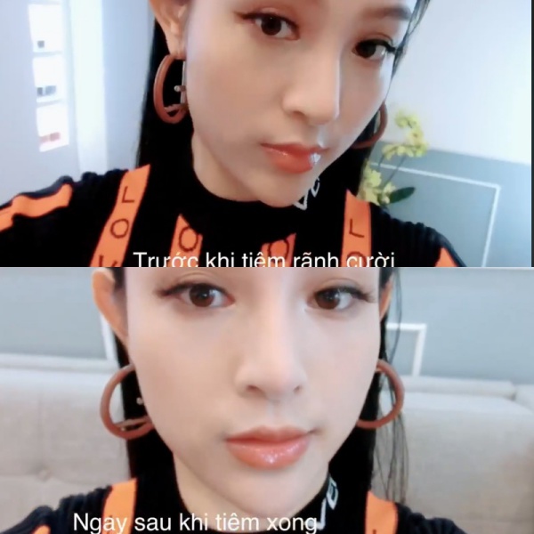 Những bộ phận có thể làm đẹp bằng filler giúp chị em amp;#34;lên đờiamp;#34; nhan sắc - 4