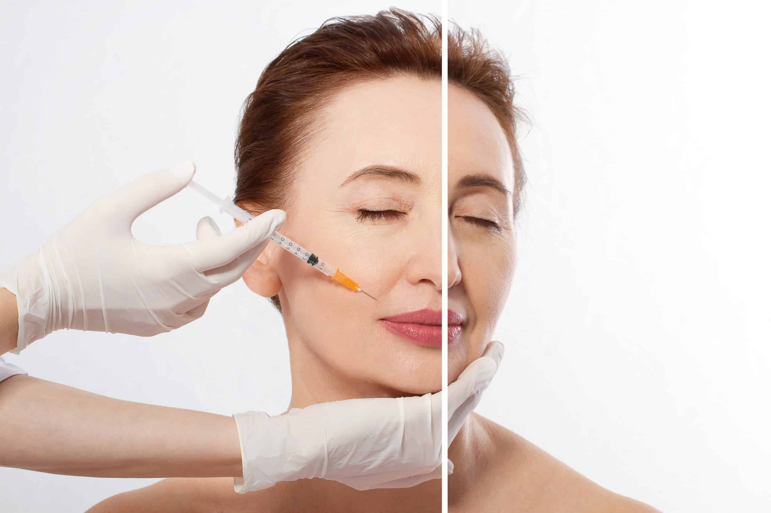 Tiêm filler là phương pháp được cho là mang lại hiệu quả tốt và độ an toàn cao nên ngày càng được nhiều người lựa chọn.