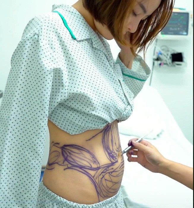 Hot girl Trâm Anh từng làm bùng nổ mạng xã hội khi cô quyết định công khai livestream phẫu thuật hút mỡ bụng của mình.